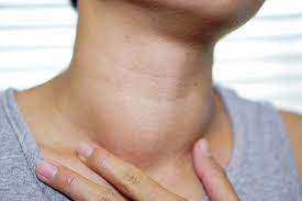 You'll also learn about different thyroid disorders, their symptoms and how they are treated. This Thyroid Disorder May Be A Marker For Covid 19 Infection