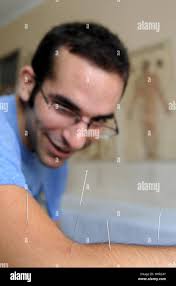 Points for acupuncture hi-res stock photography and images