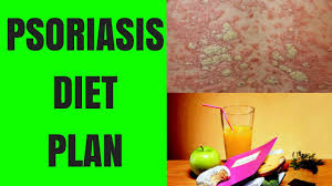 Psoriasis Diet Psoriasis Diet Plan Psoriasis Diet