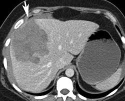 And 7 p.m., except that from july 1 to labor day, they may work until 9 p.m. Blood In The Belly Ct Findings Of Hemoperitoneum Radiographics