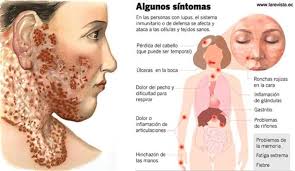 Lupus Eritematoso                                Sistémico (LES)