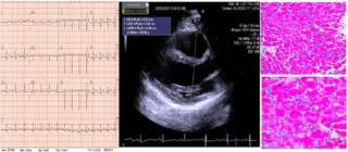 Evaluation with spin echo, cine mr angiography and contrast enhanced spin echo imaging. Diagnostic Overlap Between Arrhythmogenic Right Ventricular Dysplasia And Myocarditis Journal Of Cardiac Failure