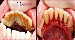 Petua Tips Untuk Hilangkan Karang Gigi Tanpa Perlu Jumpa Doktor