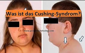 Was Ist Das Cushing Syndrom Cushing Syndrom Definition A Flickr