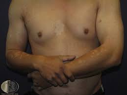 Pityriasis alba usually resolves spontaneously, thus its treatment consists primarily of good general skin care. Pityriasis Versicolor Deximed