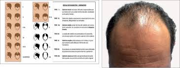 Induccion De Crecimiento Y Restauracion Del Foliculo Piloso Con Factores De Crecimiento Autologos En Patologia No Cicatrizal Del Cuero Cabelludo