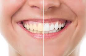 Ada banyak sekali cara memutihkan gigi yang dapat kita temukan. 5 Cara Memutihkan Gigi Kuning Yang Membandel Citra Indonesia