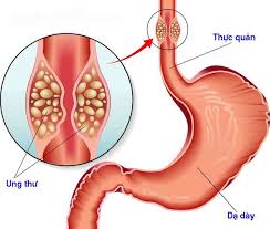 Trong đó, hang vị là phần nằm ngang của dạ dày, từ góc bờ cong nhỏ đến lỗ môn vị. Trao NgÆ°á»£c Dáº¡ Day Ä'á»™ A La Gi Vinmec
