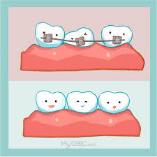 Pengalaman pakai braces di klinik kerajaan. 25 Klinik Pendakap Gigi Kanak Kanak Terbaik Malaysia Harga Ulasan