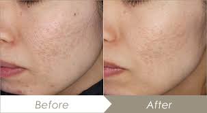 クレーター 治す 自力