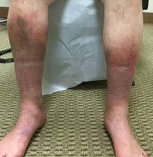 Image result for brown patches on the feet