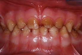 Primary Incisor And Canine Restoration In A Child With Amelogenesis Imperfecta Volume 10 Issue 12 Inside Dentistry