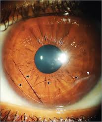 Hair In The Eye Anatomia Del Ojo Optometria Ojos