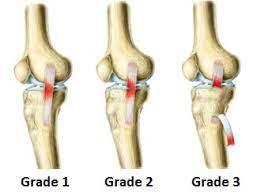 A knee sprain may involve one or more ligaments. Knee Sprain Symptoms Diagnosis Treatment Knee Pain Explained