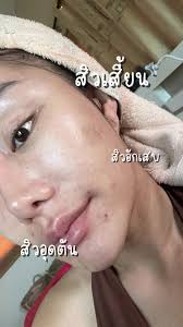 จากใจคนเป็นสิว สิวโน้น สิวนี่ สิวนั้น!! สูตรลับใช้เรตินอลคู่กับมอยส์  แก้ปัญหาตรงจุดสุดๆ #ใช้ดีบอกต่อ #tiktokuni #สิว #เรตินอล #มอยส์เจอร์  #provamed