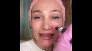 Nano Channeling, A Great Steppingstone Toward reg. Microneedling