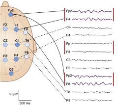 Electroencephalography | Clinical Gate