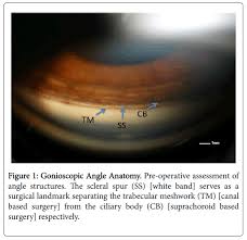 Image result for Gonioscopy