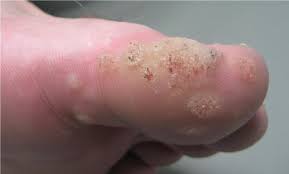 But it can be said that in india, the treatment for wart removal can be availed at rs. Treatment Of Nongenital Cutaneous Warts American Family Physician