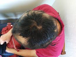 Normal hair cycle and relationship between triggers and timing of hair loss should be explained. Hair Loss Treatment Natural Tips Bloomizon
