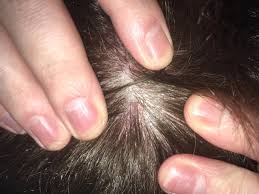Hyperthyroidism (overactive thyroid) can result in diffusely thinning hair everywhere on the head, while hypothyroidism (underactive thyroid) can cause hair loss on the head and elsewhere on the body. My Ongoing Scalp Issues Any Advice Welcome Hairlosstalk Forums