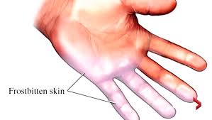 Frostbite occurs when exposure to low temperatures causes freezing of the skin or other tissues.1 the initial symptom is typically numbness.1 this may be. The Three Phases Of Frostbite From Red Skin To Black Skin Death Winnipeg Globalnews Ca