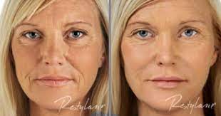 Super angebote für long lasting hier im preisvergleich. Restylane Before And After Restylane Restylane Silk Lip Enhancement