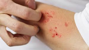 Image result for scabies symptoms