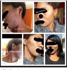 Believe it or not, dencia's whitenicious is taking her places. Stella Dimoko Korkus Com Whitenicious Is Changing Lives