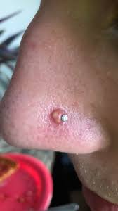 Tea tree oil is effective because it is naturally antibacterial. Nose Piercing Issues The Bump Popped Up A Few Weeks After Piercing Piercer Said To Apply Tea Tree Oil It S Been Two Months And It Fluctuates Between Growing And Shrinking Two Days