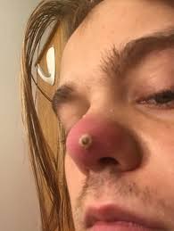 Treatment with antibiotics such as dicloxacillin is needed for 7 to 10 days. Can Someone Tell Me What This Is It S Sore And My Nose Is Also Swollen Medical