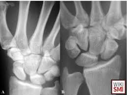 Image result for Scapholunate Dislocation