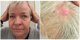 Cutaneous Expression of Familial Cancer Syndromes