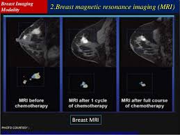 You can get dressed straight after the ultrasound. What Does Breast Cancer Look Like In An Ultrasound