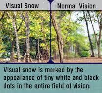 Summary recent evidence suggests visual snow is a complex neurological syndrome characterized by debilitating visual. 16 Visual Snow Syndrome Ideas Visual Snow Visual Snow Images