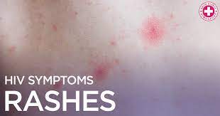 Symptoms of hiv vary from one person to another. Hiv Rash Singapore Hiv Rash Shim Clinic