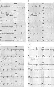 Normalization Of Qt Interval Duration In A Long Qt Syndrome Patient During Pregnancy And The Postpartum Period Due To Sex Hormone Effects On Cardiac Repolarization Heartrhythm Case Reports