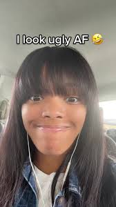 Teeth Extraction Before and After: My Ugly AF Experience