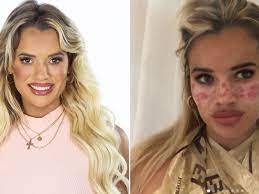 Australian big brother's tilly whitfield warns about tiktok freckle hack that caused her temporary blindness & scars. Big Brother Australia 2021 Star Tilly Whitfeld Reveals Why She Was Hospitalised After Attempting Tiktok Procedure 7news