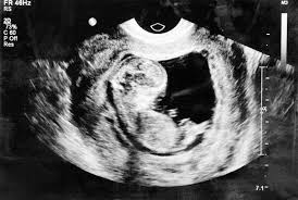 Gambaran usg janin perempuan usia kehamilan 29 minggu 3 hari youtube. Ini Rata Rata Berat Janin 5 Bulan Alodokter