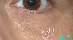 Mix equal parts water and apple cider vinegar and drink it before you eat. Syringoma Online Dermatology