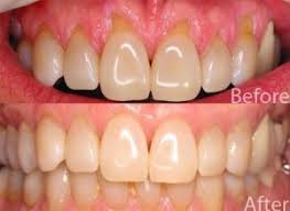 Receding Gums Treatment Pearl Dental Clinic Kingston London