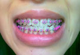 Tumblr M4xdtzh04s1r5ma9h Jpg 500 344 Ligas Para Brackets Brackets Dentales Brackets