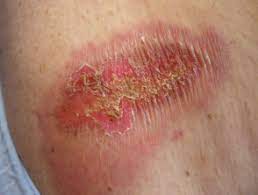 Iodine Dermnet Nz