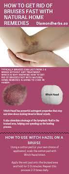 Natural Ways To Get Rid Of Bruises And Speed Up The Healing Process Bruises Natural Home Remedies Skin Natural Remedies