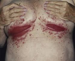 Image result for Candidiasis under breasts