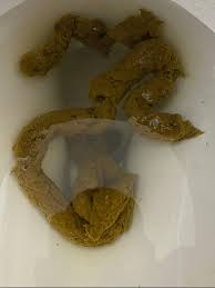 Image result for thin ribbon stools human poop