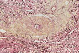 Düsterroten oder auch hellroten entzündungssaum. Ulcus Hypertensivum Van Martorell