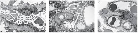 Thin basement membrane disease is a benign kidney condition that results in the thinning of the tissue in the glomeruli, structures in your body which are responsible for filtering your blood. Inherited Diseases Of The Glomerular Basement Membrane Nature Reviews Nephrology