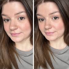 Rhinoplasty for bulbous tip reduction